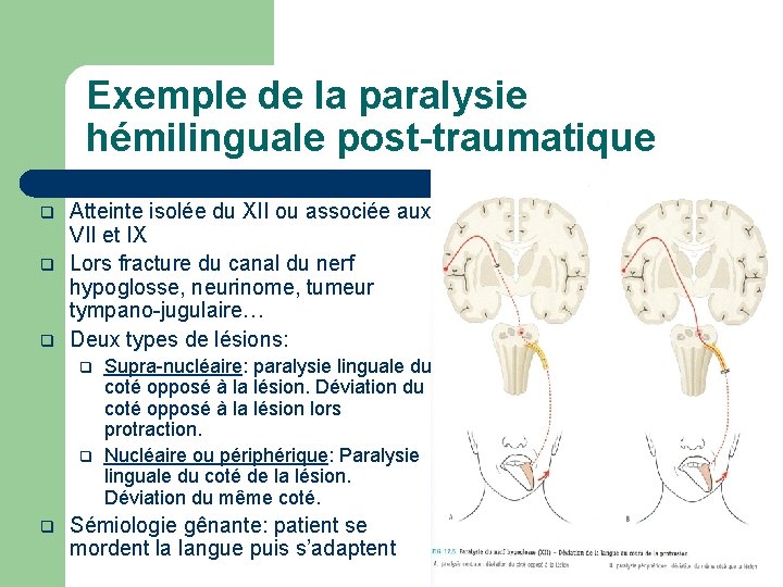 Exemple de la paralysie hémilinguale post-traumatique q q q Atteinte isolée du XII ou