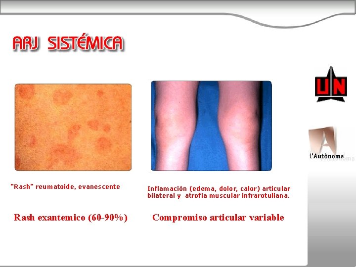 "Rash" reumatoide, evanescente Rash exantemico (60 -90%) Inflamación (edema, dolor, calor) articular bilateral y