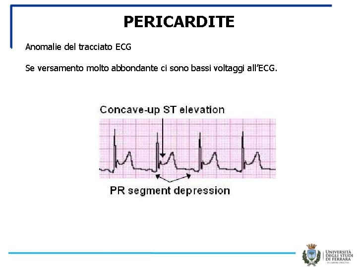 PERICARDITE Anomalie del tracciato ECG Se versamento molto abbondante ci sono bassi voltaggi all’ECG.