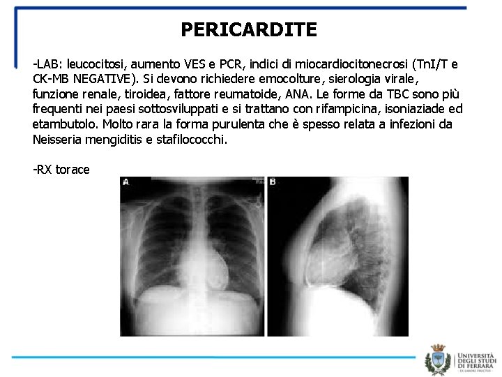 PERICARDITE -LAB: leucocitosi, aumento VES e PCR, indici di miocardiocitonecrosi (Tn. I/T e CK-MB