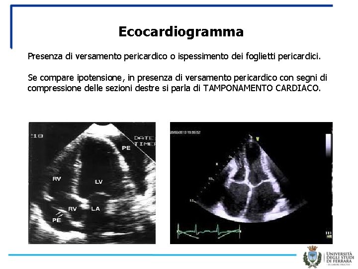 Ecocardiogramma Presenza di versamento pericardico o ispessimento dei foglietti pericardici. Se compare ipotensione, in