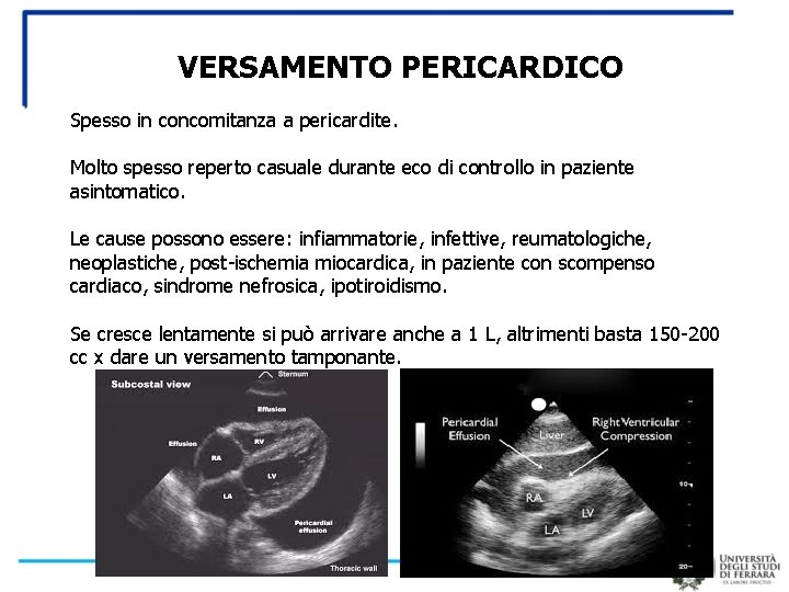 VERSAMENTO PERICARDICO Spesso in concomitanza a pericardite. Molto spesso reperto casuale durante eco di