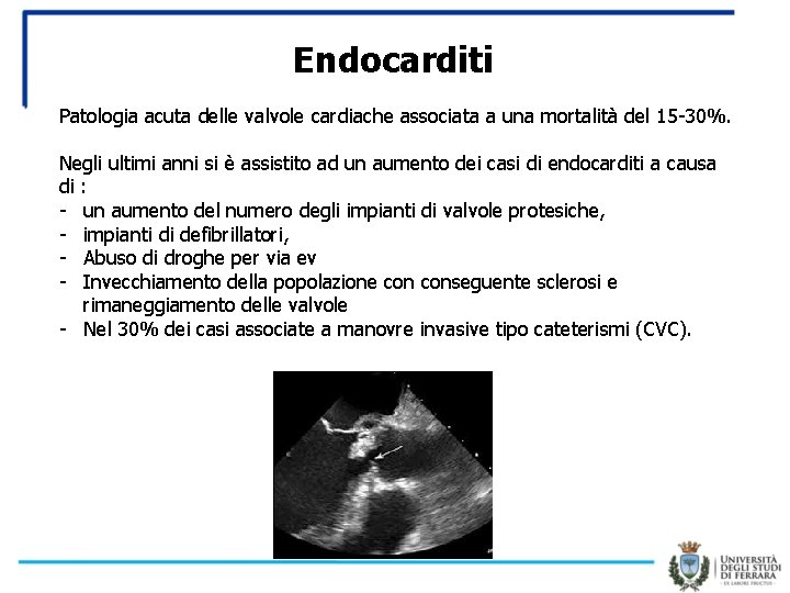 Endocarditi Patologia acuta delle valvole cardiache associata a una mortalità del 15 -30%. Negli