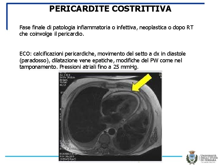 PERICARDITE COSTRITTIVA Fase finale di patologia infiammatoria o infettiva, neoplastica o dopo RT che