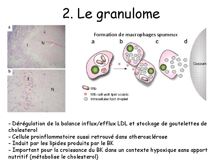 2. Le granulome Formation de macrophages spumeux - Dérégulation de la balance influx/efflux LDL