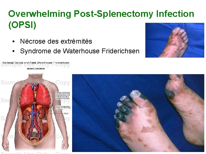 Overwhelming Post-Splenectomy Infection (OPSI) • Nécrose des extrémités • Syndrome de Waterhouse Friderichsen 