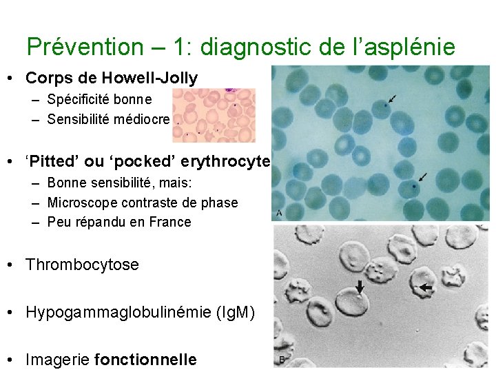 Prévention – 1: diagnostic de l’asplénie • Corps de Howell-Jolly – Spécificité bonne –