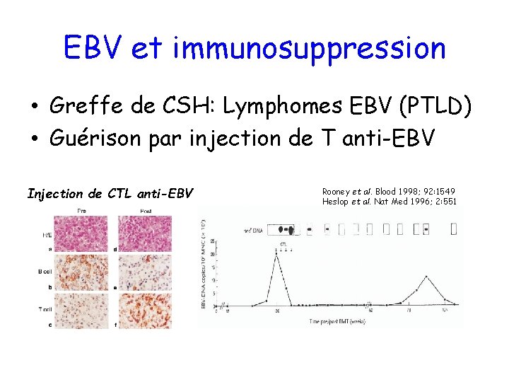 EBV et immunosuppression • Greffe de CSH: Lymphomes EBV (PTLD) • Guérison par injection