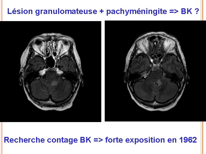 Lésion granulomateuse + pachyméningite => BK ? Recherche contage BK => forte exposition en