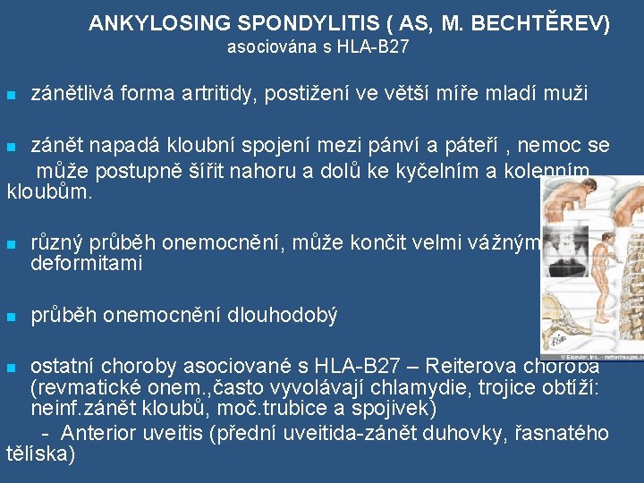  ANKYLOSING SPONDYLITIS ( AS, M. BECHTĚREV) asociována s HLA-B 27 n zánětlivá forma