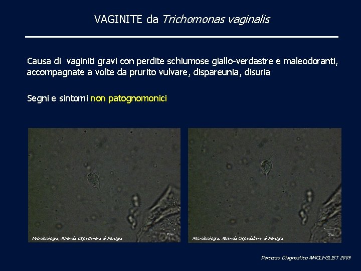 VAGINITE da Trichomonas vaginalis Causa di vaginiti gravi con perdite schiumose giallo-verdastre e maleodoranti,