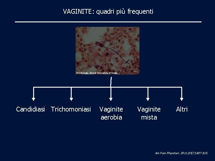 VAGINITE: quadri più frequenti Microbiologia, Azienda Ospedaliera di Perugia Candidiasi Trichomoniasi Vaginite aerobia Vaginite