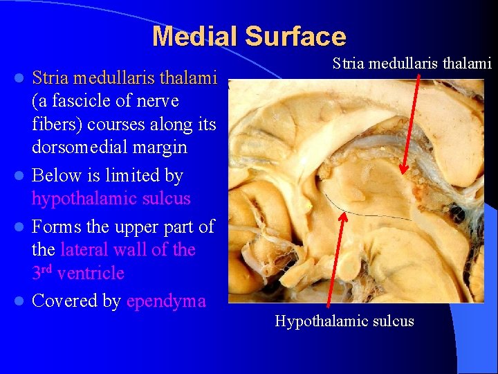 Medial Surface Stria medullaris thalami (a fascicle of nerve fibers) courses along its dorsomedial