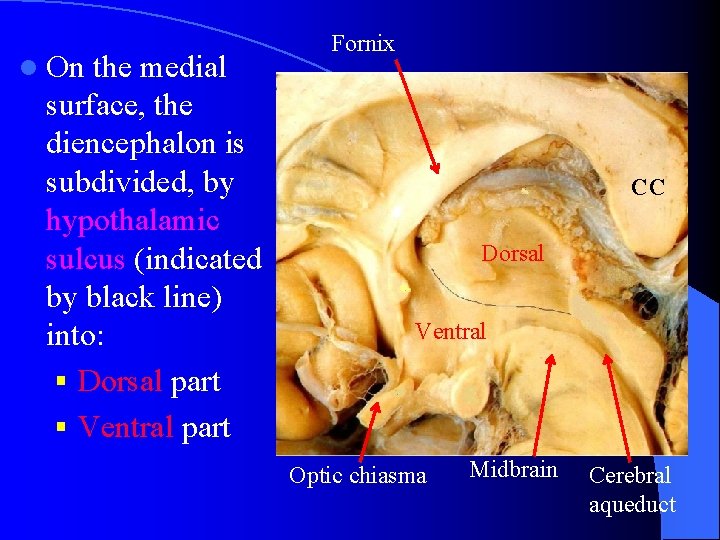 l On the medial surface, the diencephalon is subdivided, by hypothalamic sulcus (indicated by
