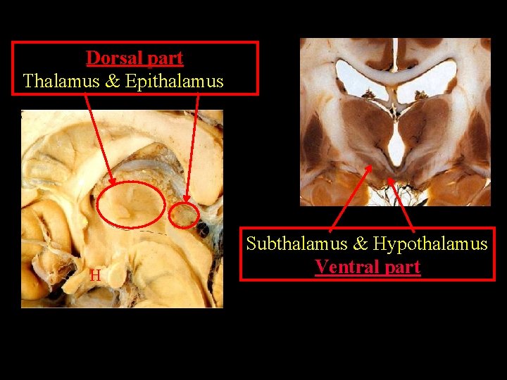 Dorsal part Thalamus & Epithalamus H Subthalamus & Hypothalamus Ventral part 