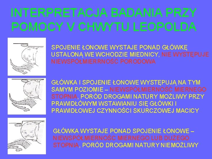 INTERPRETACJA BADANIA PRZY POMOCY V CHWYTU LEOPOLDA SPOJENIE ŁONOWE WYSTAJE PONAD GŁÓWKĘ USTALONĄ WE