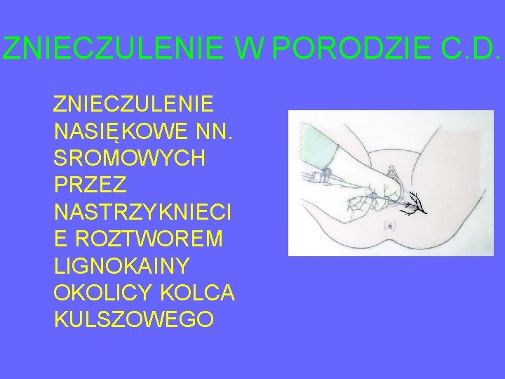 ZNIECZULENIE W PORODZIE C. D. ZNIECZULENIE NASIĘKOWE NN. SROMOWYCH PRZEZ NASTRZYKNIECI E ROZTWOREM LIGNOKAINY