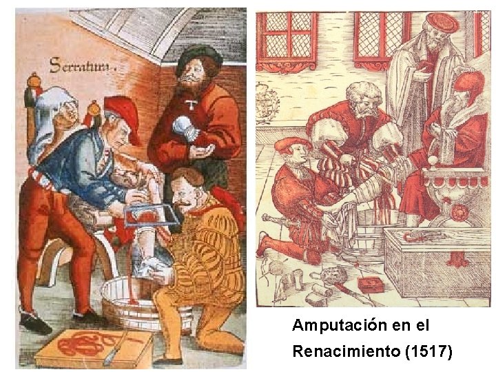 Amputación en el Renacimiento (1517) 