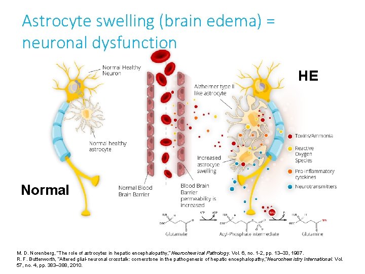 Astrocyte swelling (brain edema) = neuronal dysfunction HE Normal M. D. Norenberg, “The role