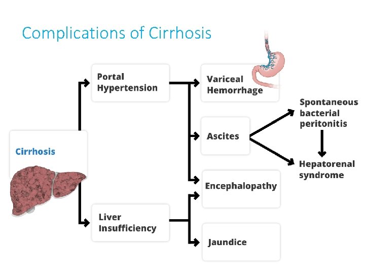 Complications of Cirrhosis 