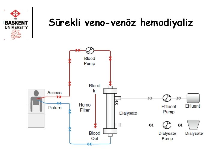 Sürekli veno-venöz hemodiyaliz 