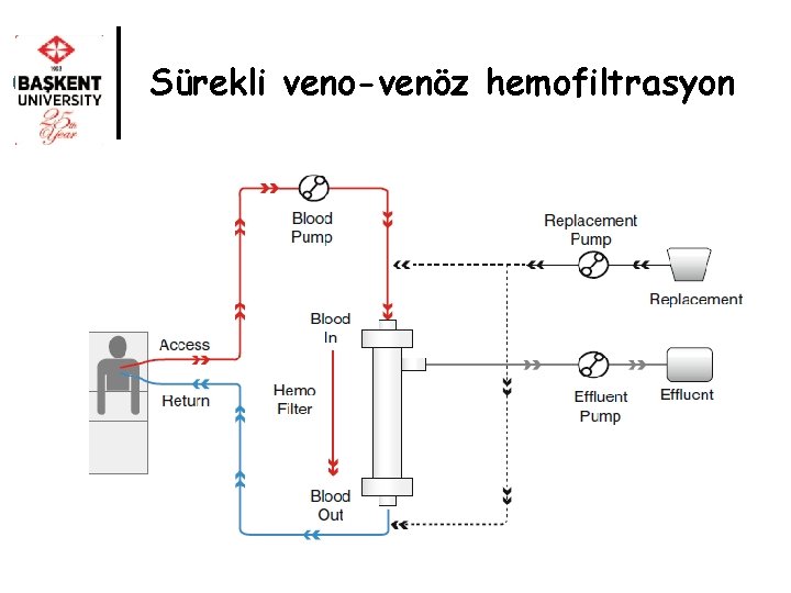 Sürekli veno-venöz hemofiltrasyon 