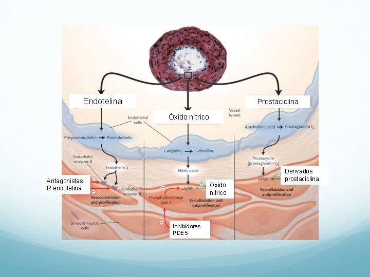Endotelina Prostaciclina Óxido nítrico Antagonistas R endotelina Oxido nitrico Inhibidores PDE 5 Derivados prostaciclina Endotelina Prostaciclina Óxido nítrico Antagonistas R endotelina Oxido nitrico Inhibidores PDE 5 Derivados prostaciclina