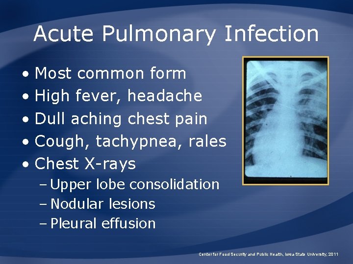 Acute Pulmonary Infection • Most common form • High fever, headache • Dull aching