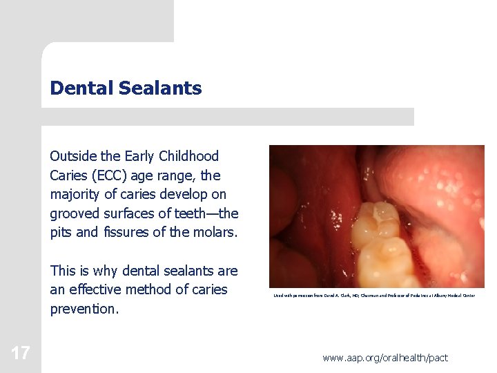 Dental Sealants Outside the Early Childhood Caries (ECC) age range, the majority of caries
