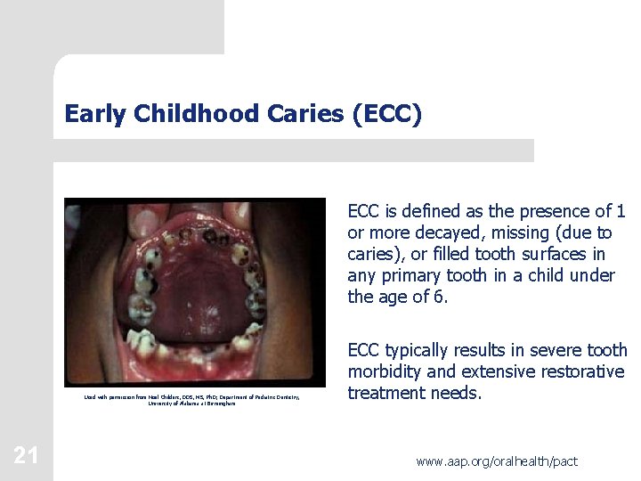 Early Childhood Caries (ECC) ECC is defined as the presence of 1 or more
