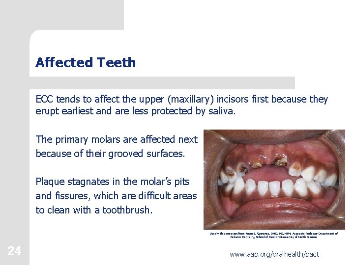 Affected Teeth ECC tends to affect the upper (maxillary) incisors first because they erupt