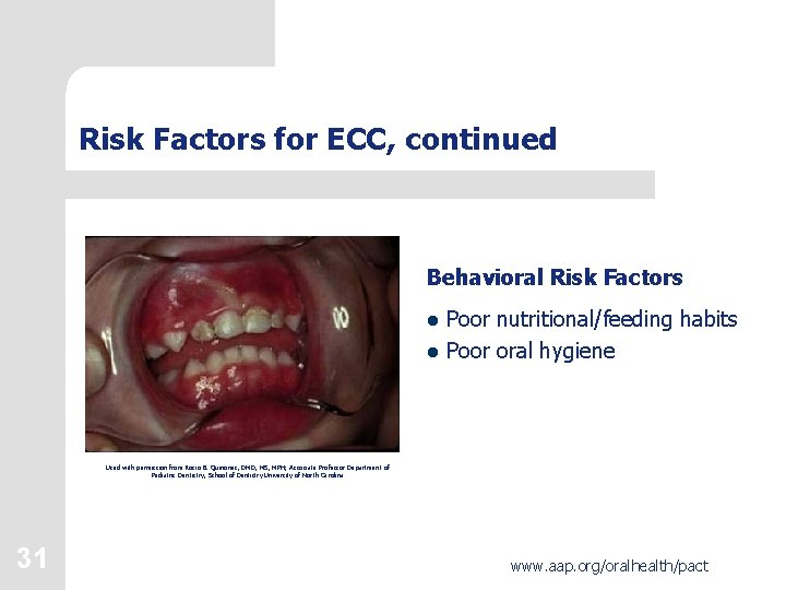 Risk Factors for ECC, continued Behavioral Risk Factors l Poor nutritional/feeding habits l Poor