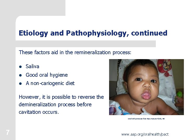 Etiology and Pathophysiology, continued These factors aid in the remineralization process: l Saliva l