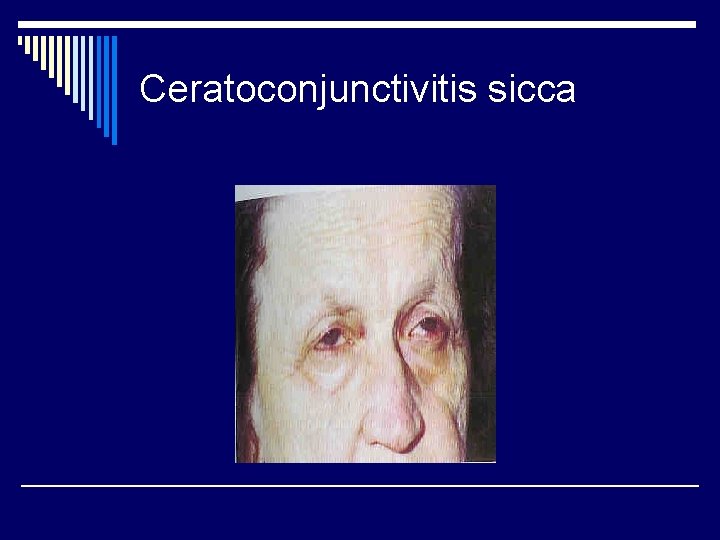 Ceratoconjunctivitis sicca Ceratoconjunctivitis sicca
