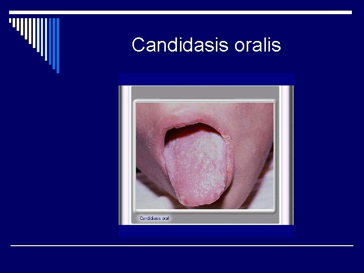 Candidasis oralis Candidasis oralis