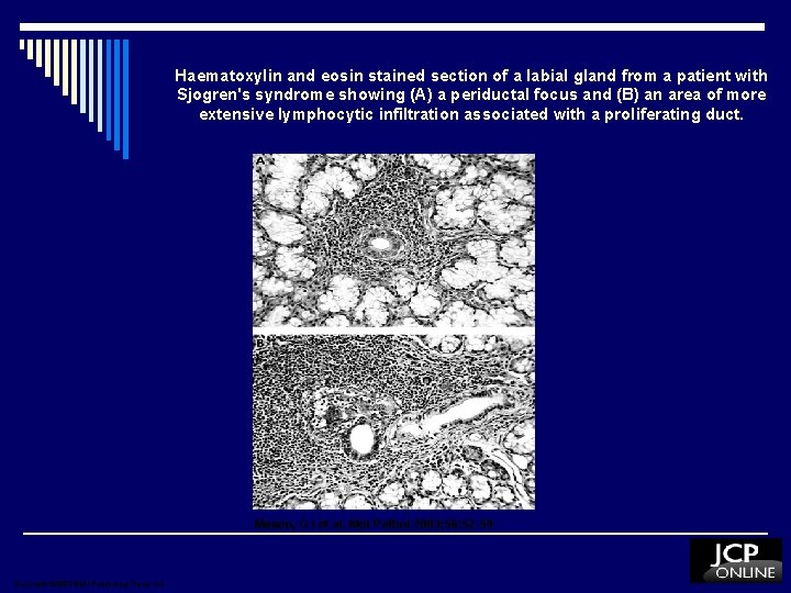Haematoxylin and eosin stained section of a labial gland from a patient with Sjogren's Haematoxylin and eosin stained section of a labial gland from a patient with Sjogren's