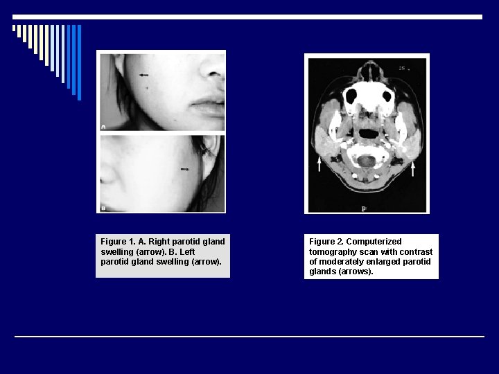 Figure 1. A. Right parotid gland swelling (arrow). B. Left parotid gland swelling (arrow).