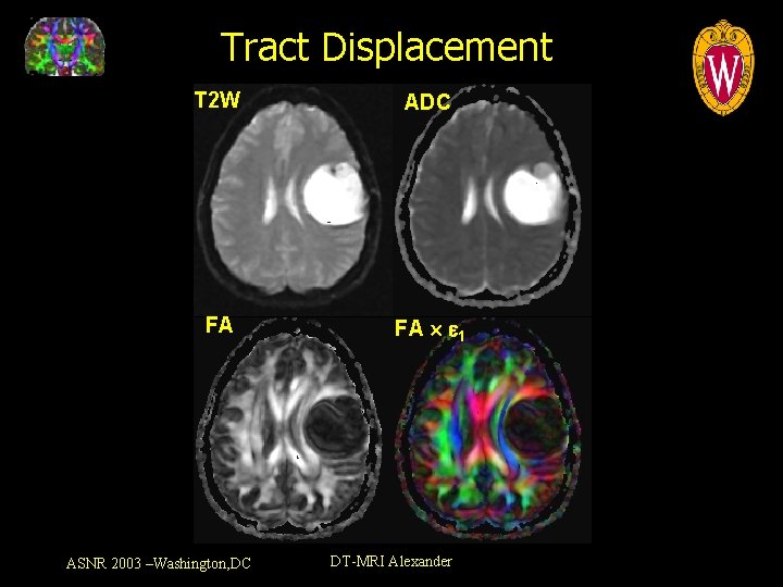 Tract Displacement T 2 W ADC FA FA 1 ASNR 2003 –Washington, DC DT-MRI
