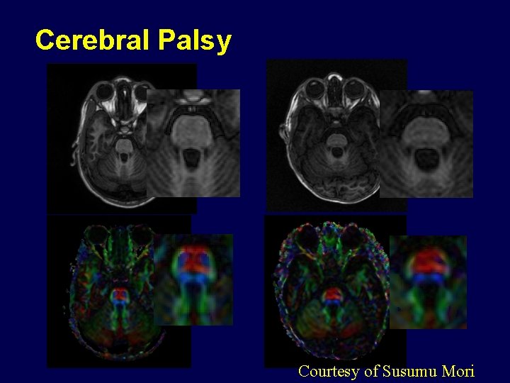 Cerebral Palsy Courtesy of Susumu Mori 