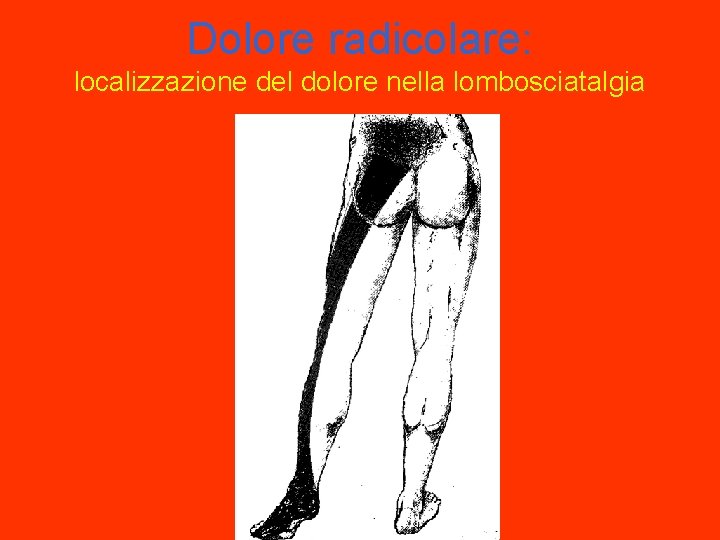 Dolore radicolare: localizzazione del dolore nella lombosciatalgia 