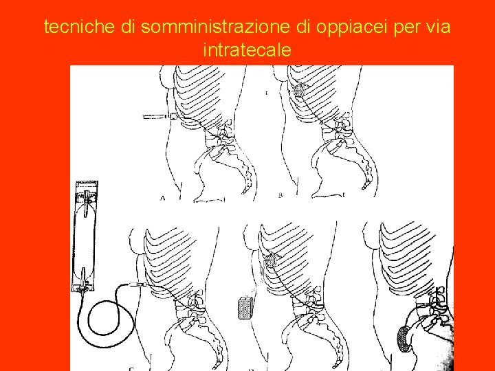 tecniche di somministrazione di oppiacei per via intratecale 