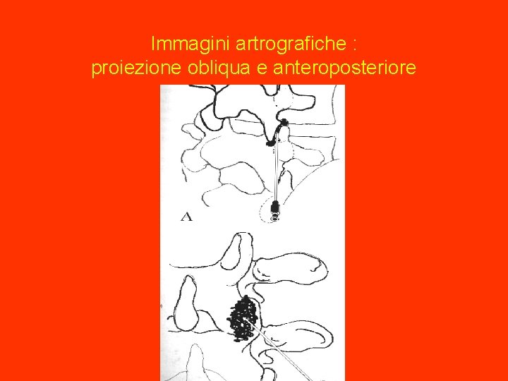 Immagini artrografiche : proiezione obliqua e anteroposteriore 