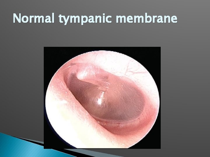 Normal tympanic membrane 