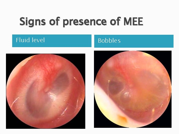 Signs of presence of MEE Fluid level Bobbles 