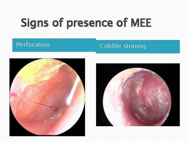 Signs of presence of MEE Perforation Cobble stoning 