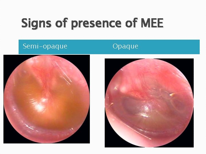Signs of presence of MEE Semi-opaque Opaque 
