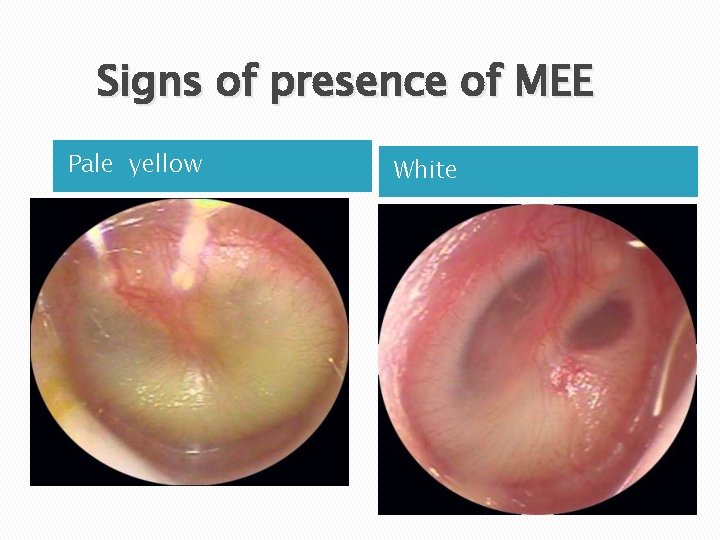 Signs of presence of MEE Pale yellow White 