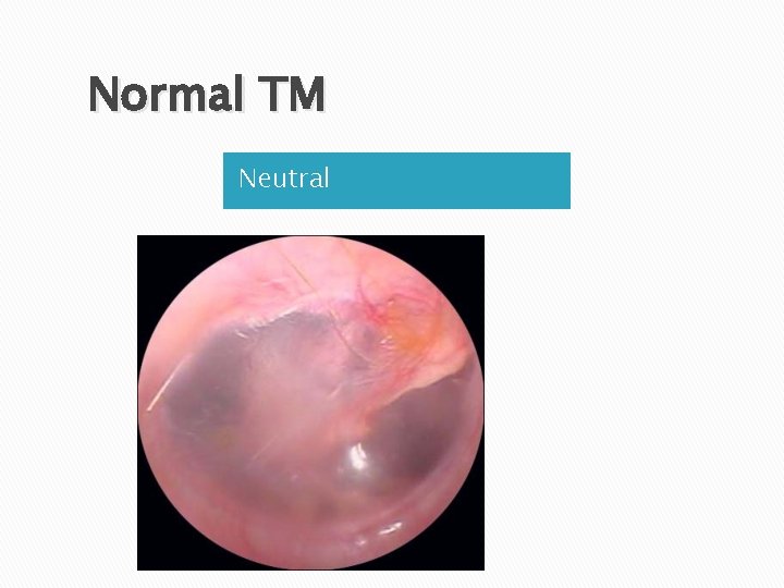 Normal TM Neutral 