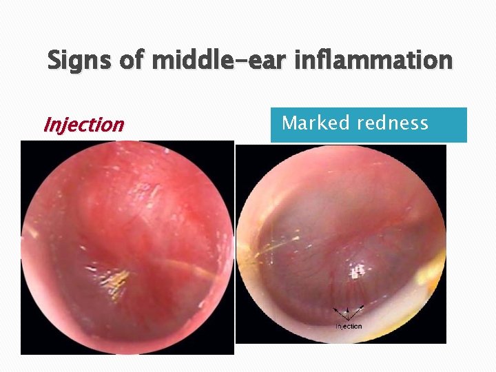 Signs of middle-ear inflammation Injection Marked redness 