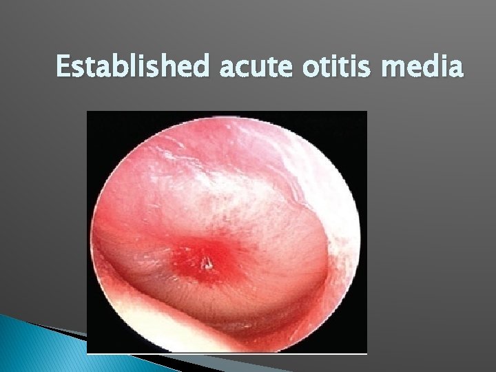 Established acute otitis media 